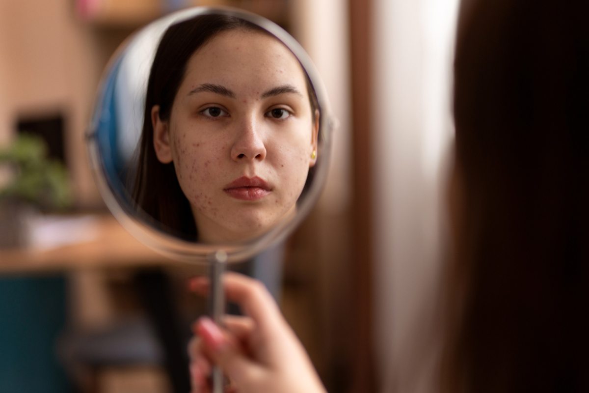 How to Get Rid of Acne Scars: Tips and Treatments